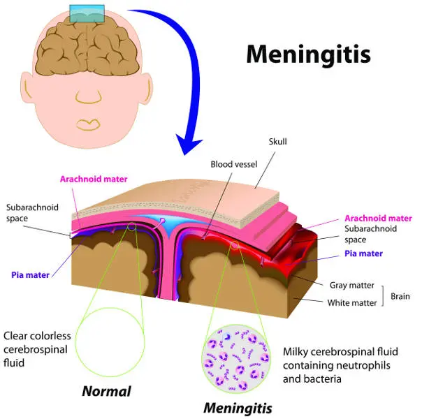 Fungal inflammation of the meninges and the brain