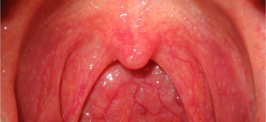 Fungal pharyngitis ma tonsillitis - auga ma togafitiga