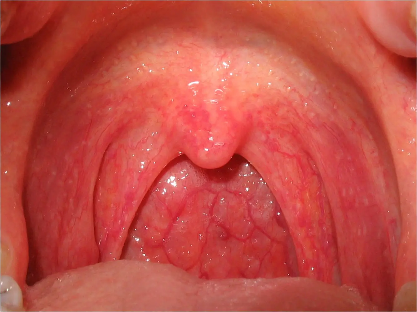 Fungal pharyngitis and tonsillitis &#8211; symptoms and treatment