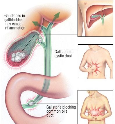 Gall bladder &#8211; symptoms of acute inflammation