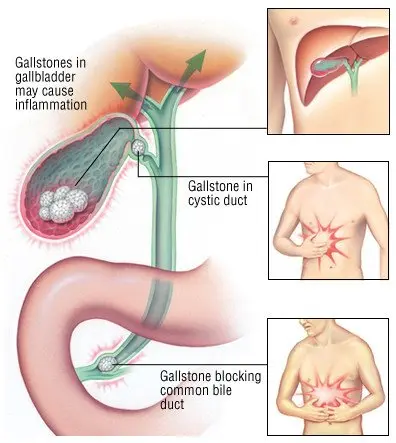 Gall bladder &#8211; symptoms of acute inflammation