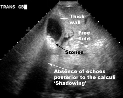 Gallbladder ultrasound &#8211; how to interpret the results?