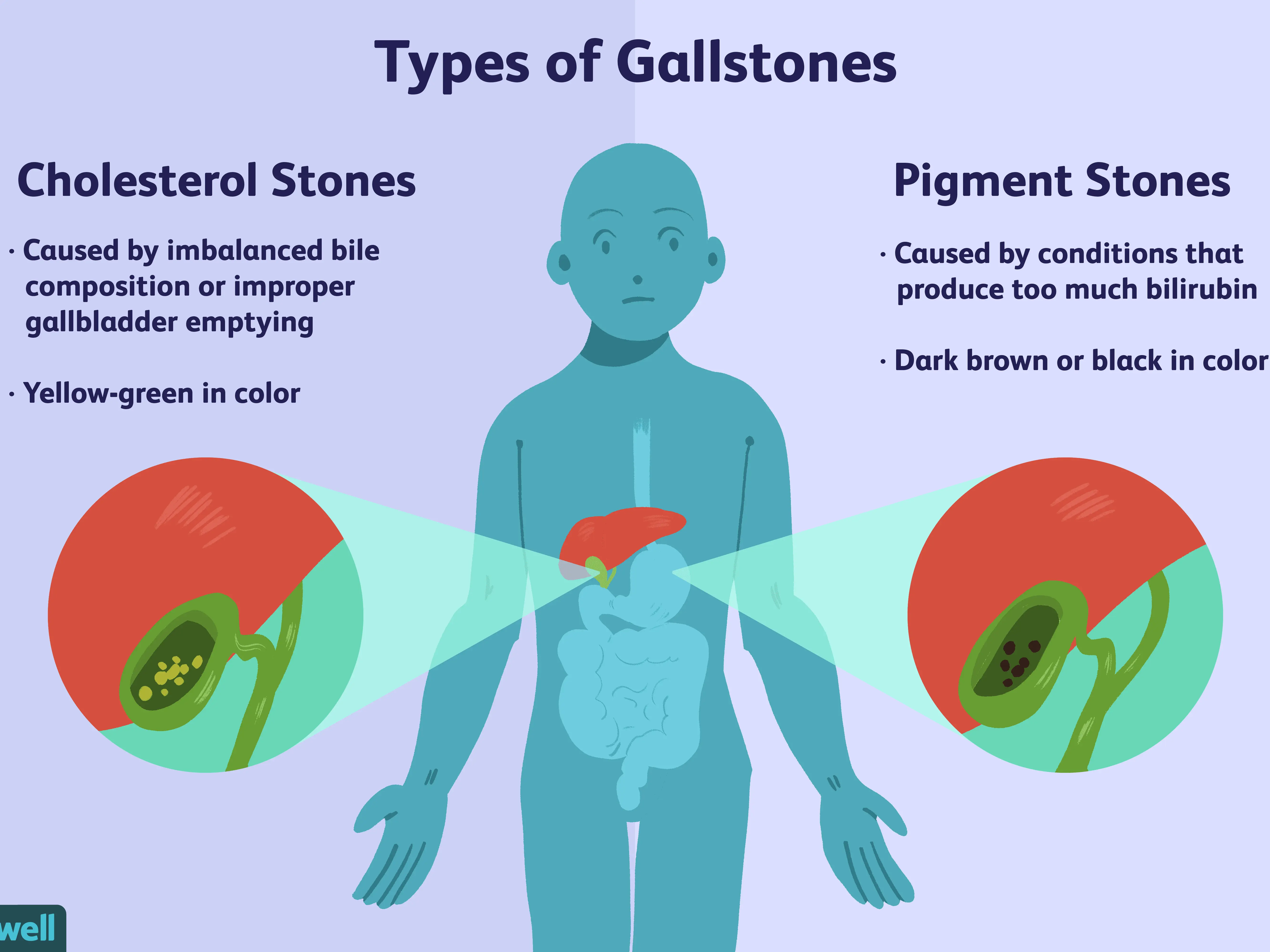 Gallstones &#8211; causes, symptoms, treatment