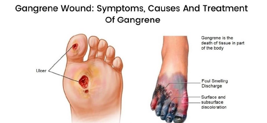 Gangrene (gangrene) &#8211; symptoms, causes, treatment, prevention