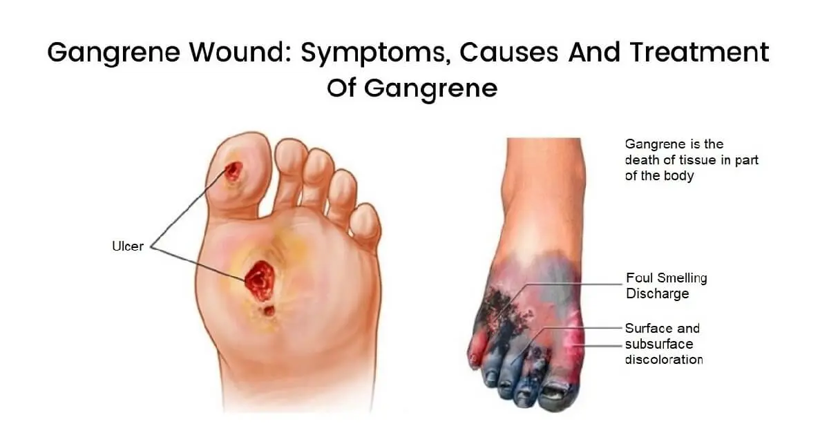 Gangrene (gangrene) &#8211; symptoms, causes, treatment, prevention