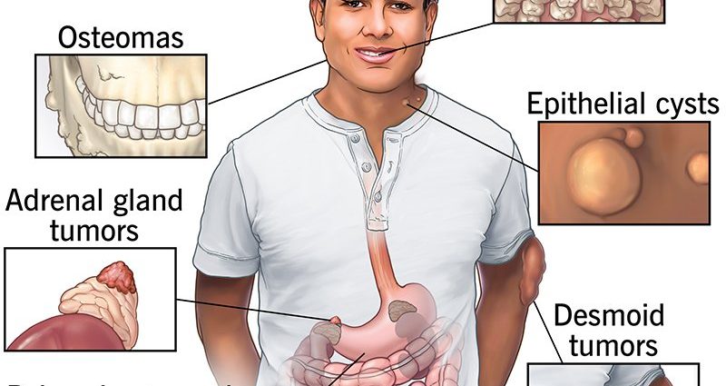 Gardner&#8217;s syndrome &#8211; causes, symptoms, prognosis. What is the treatment like?