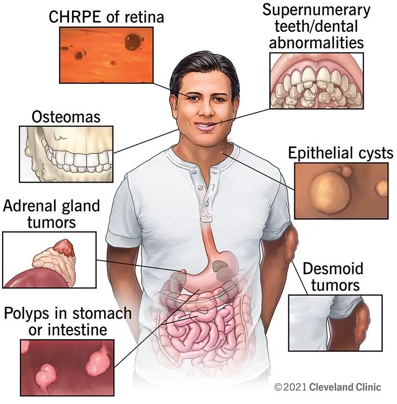 Gardner&#8217;s syndrome &#8211; causes, symptoms, prognosis. What is the treatment like?