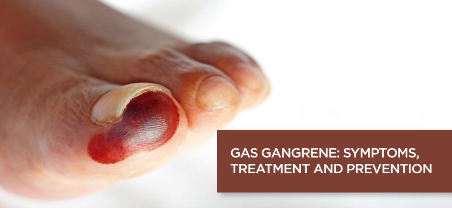 Gas gangrene &#8211; symptoms, treatment