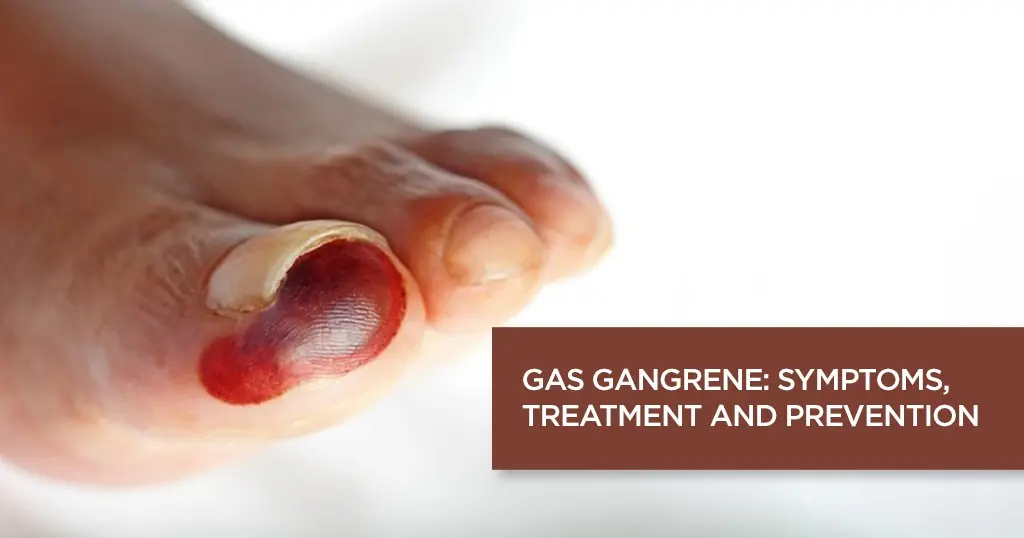 Gas gangrene &#8211; symptoms, treatment