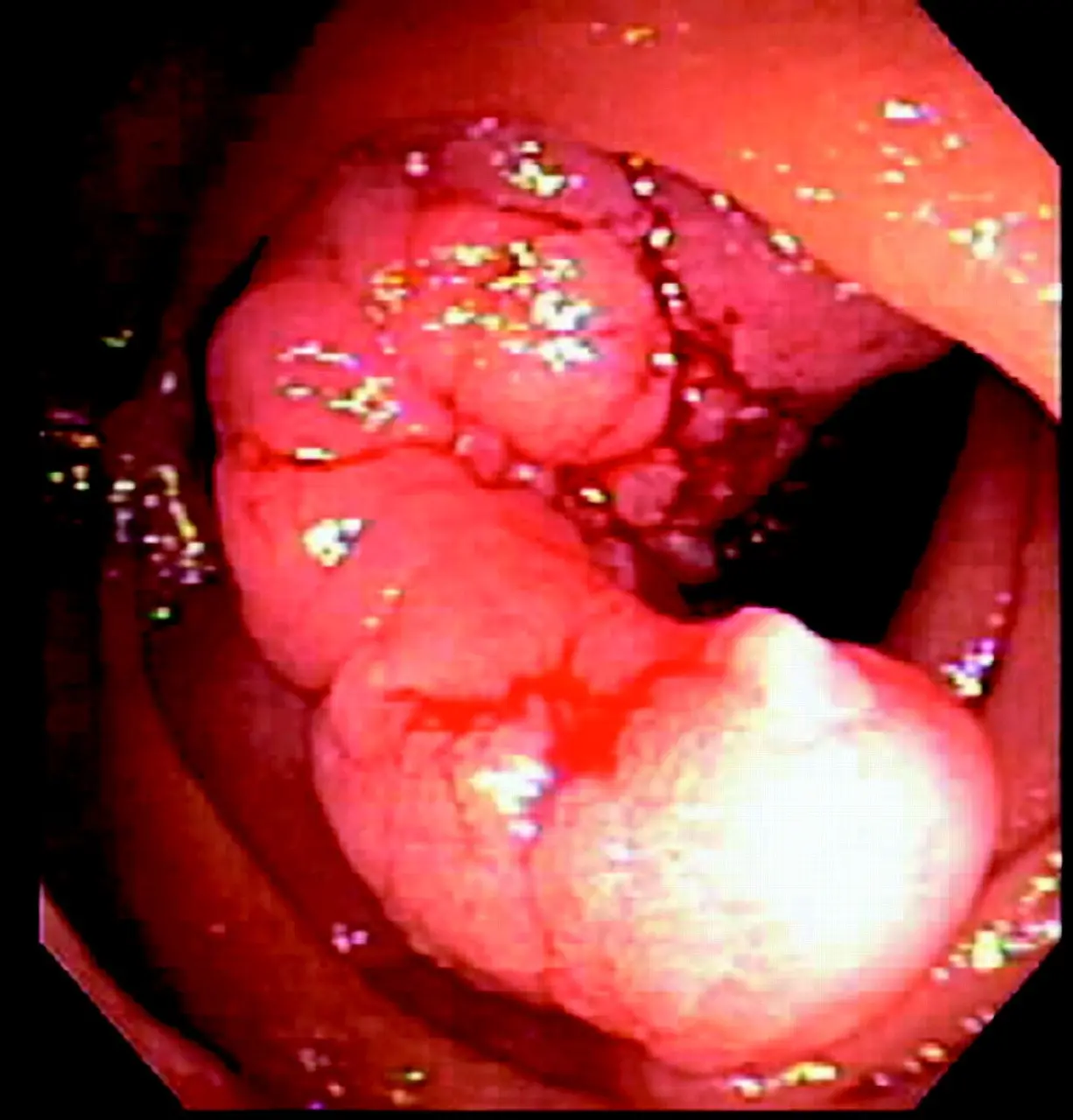 Gastric and duodenal polyps &#8211; diagnosis and treatment