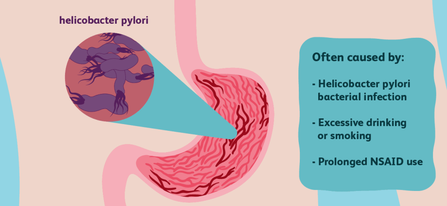 Gastritis &#8211; causes, types, symptoms, treatment