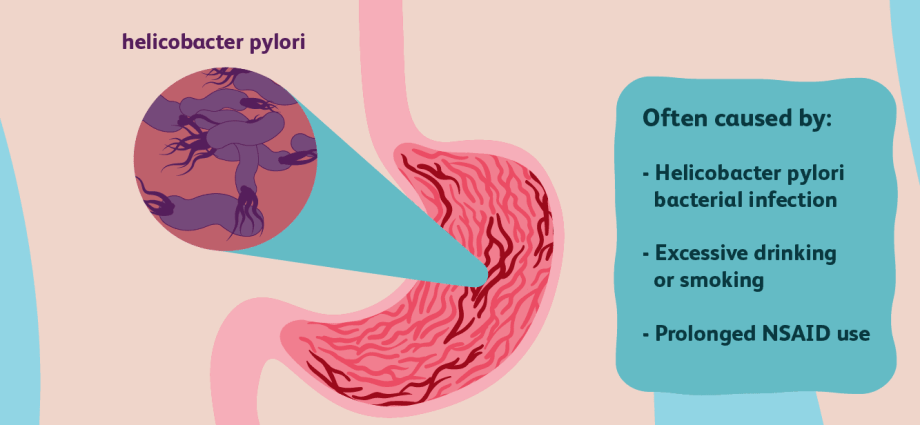 Gastritis &#8211; symptoms, causes, diagnosis, treatment