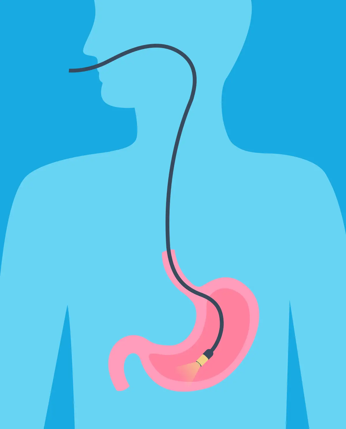 Gastroscopy &#8211; indications, preparation for examination and anesthesia. Does gastroscopy hurt?