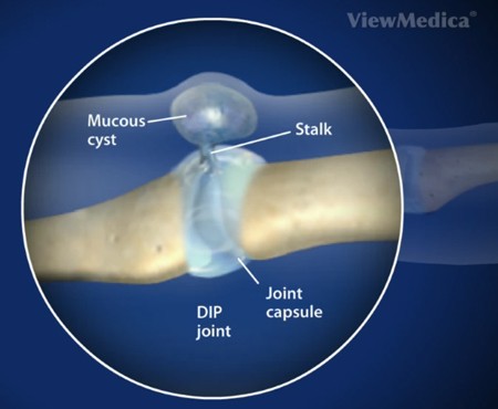 Gelatinous cyst