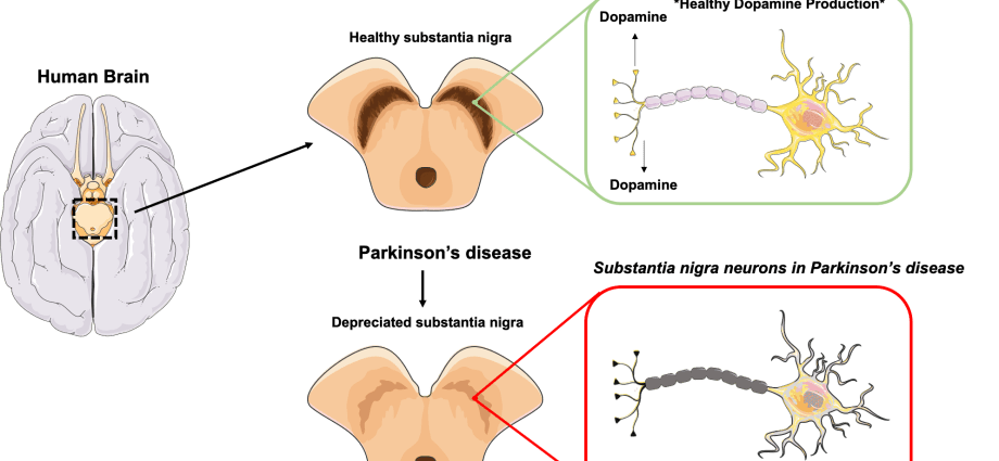 Gene therapy really works for Parkinson&#8217;s patients