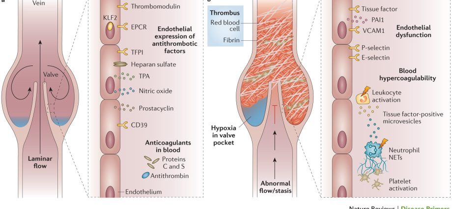 Genetic thrombosis &#8211; mutations, hormone therapies, lifestyle