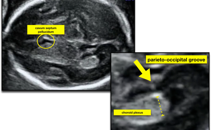 Genetic ultrasound &#8211; characteristics, course of examination and dates