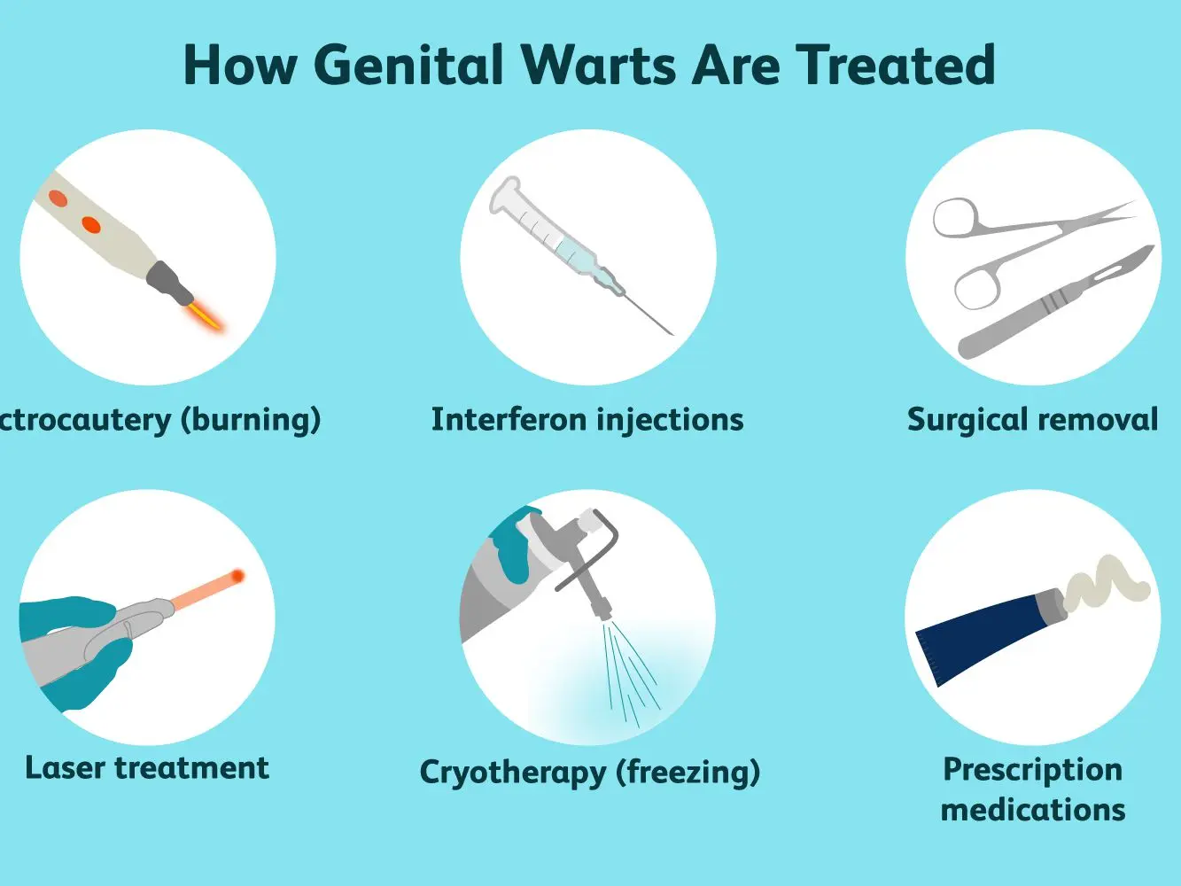 Genital warts &#8211; symptoms, treatment