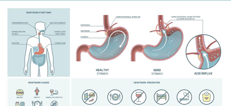 GERD &#8211; causes, symptoms and treatment methods