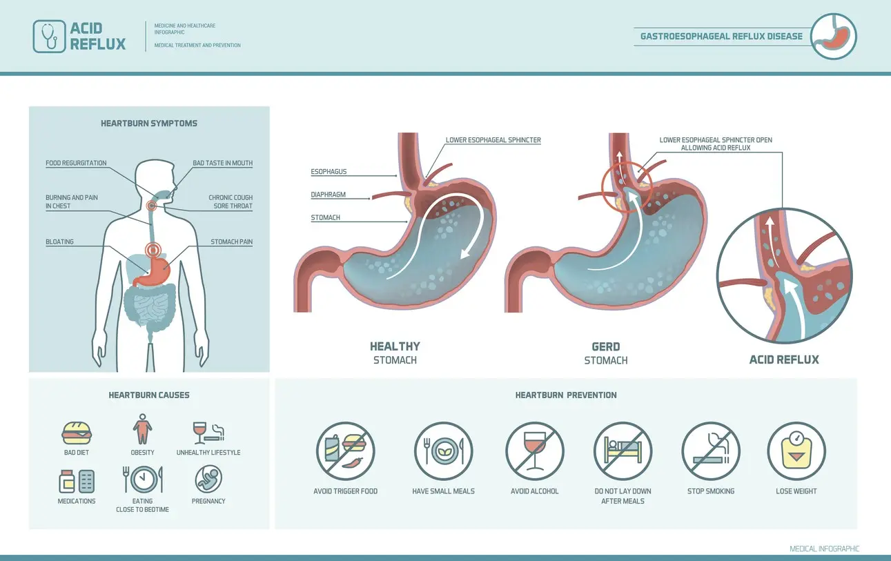 GERD &#8211; causes, symptoms and treatment methods