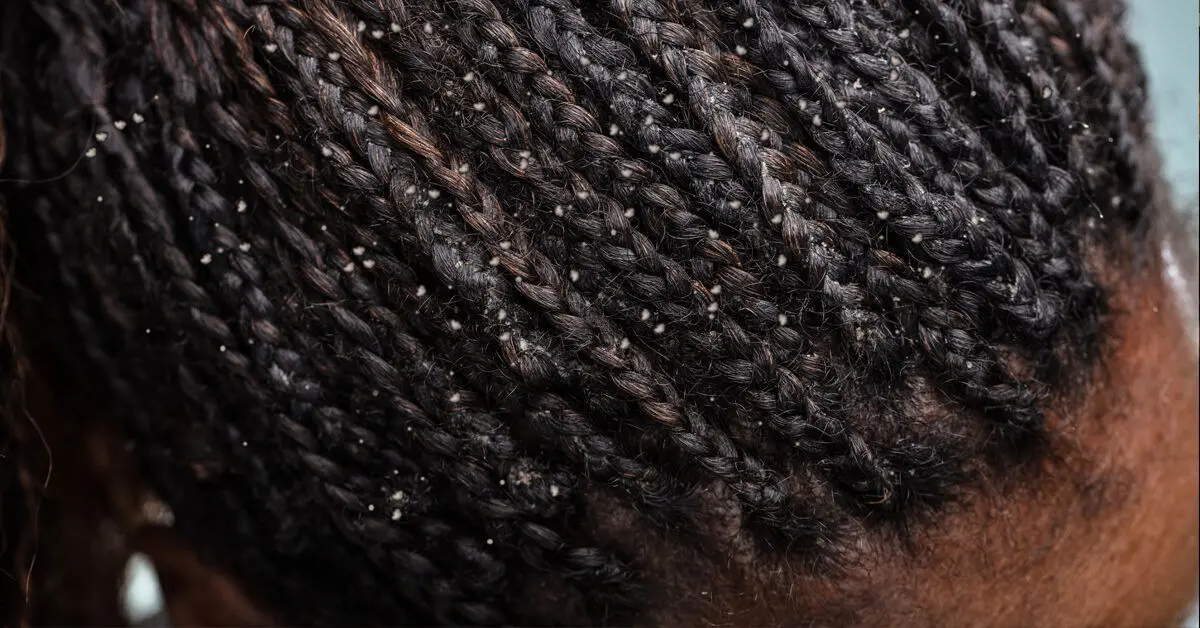 Get dandruff out of your head. What are the types of dandruff and what is the treatment like?