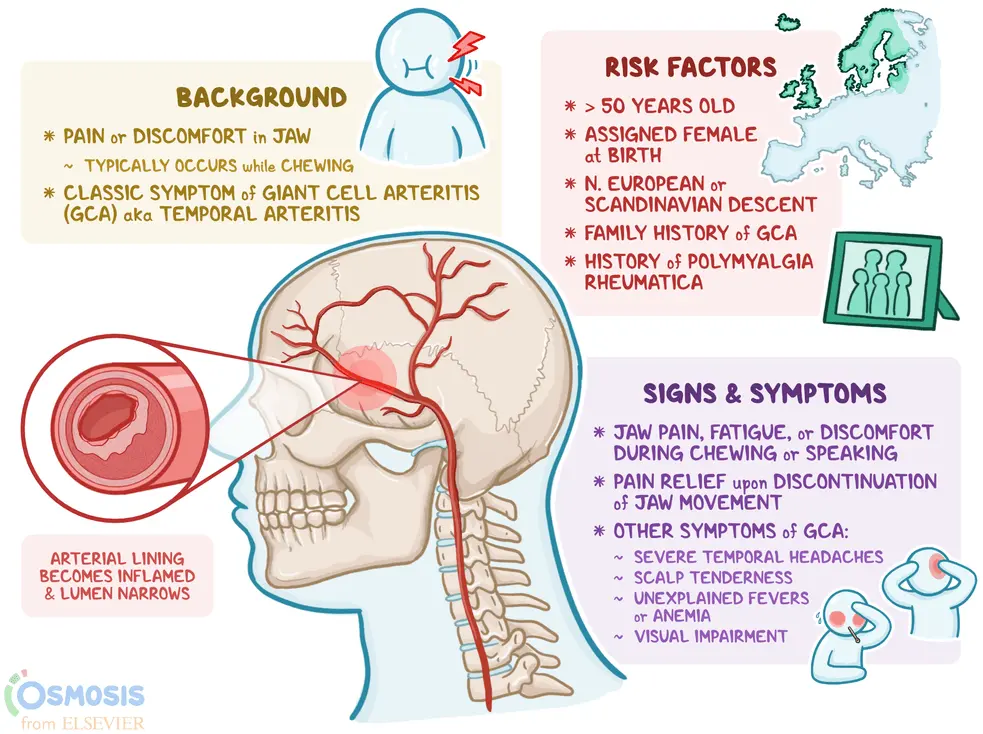 Giant cell arteritis &#8211; causes, symptoms and treatment