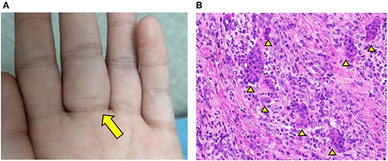 Giant cell tumor of the tendon sheath