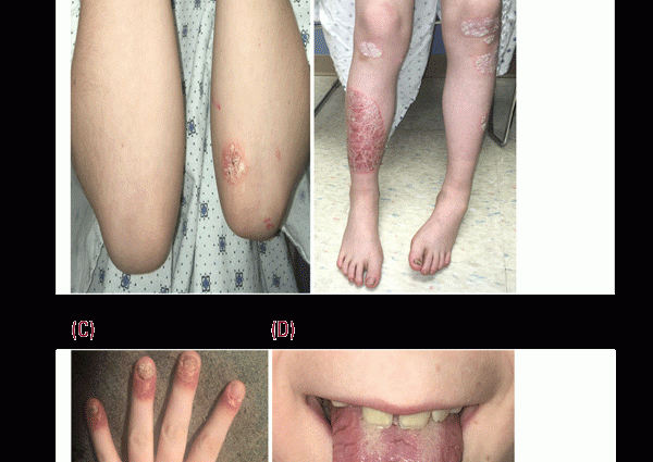 GIF banned the sale of ointments used to treat inflammatory skin lesions