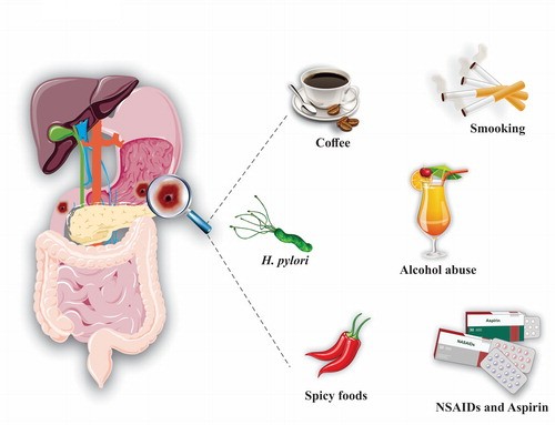 GIF is recalling gastric ulcer drug