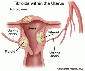 GIF suspends drugs used to treat uterine fibroids from the market