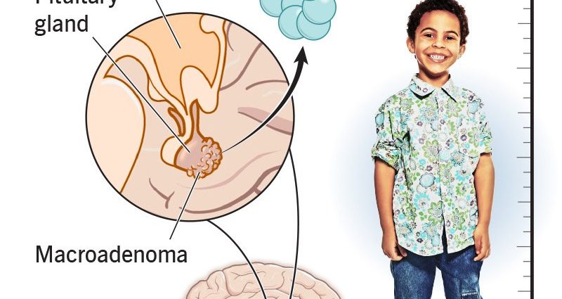 Gigantism &#8211; types, causes, symptoms, diagnosis, treatment