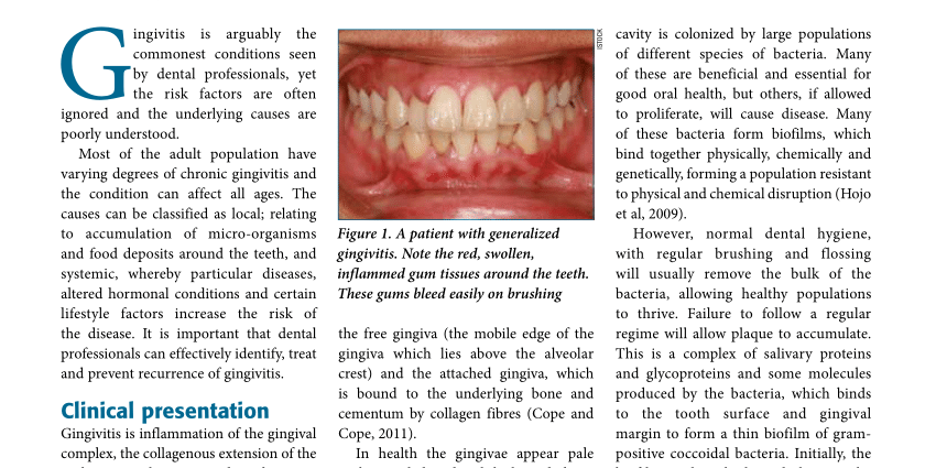 Gingivitis &#8211; causes, symptoms, treatment, complications. Gingivitis prevention