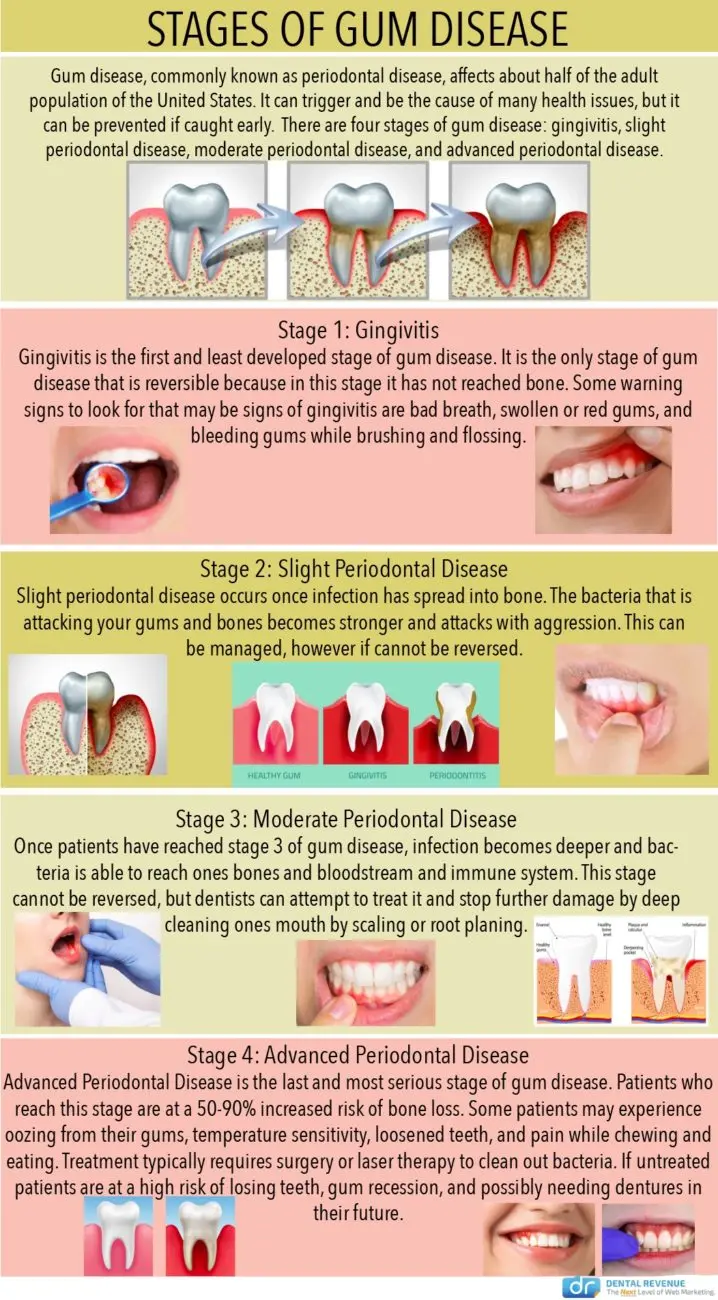 Gingivitis &#8211; how to treat? How to deal with bleeding gums?