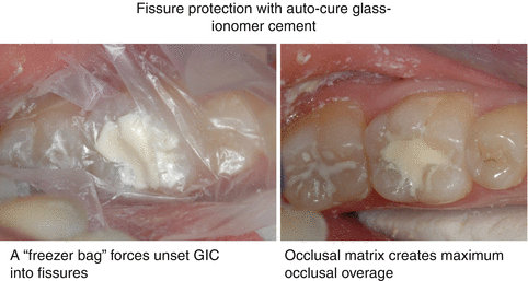 Glass ionomer fillings &#8211; when are these types of seals used?