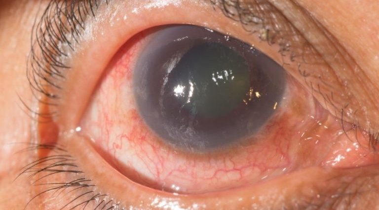 Glaucoma &#8211; a dangerous eye disease. How to recognize and treat it?