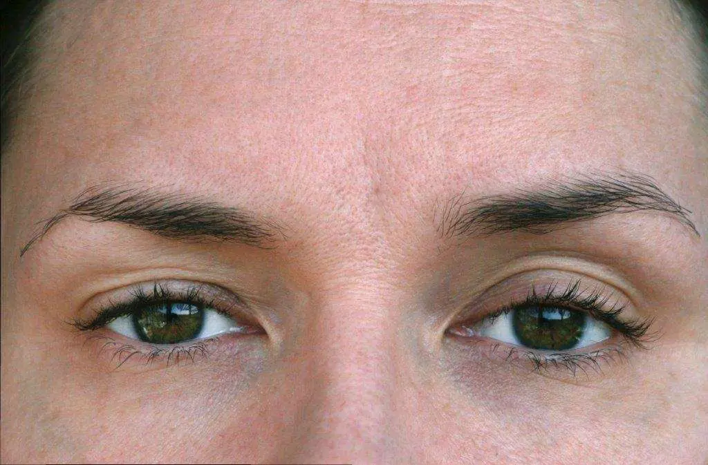 Glaucoma medications can cause ptosis