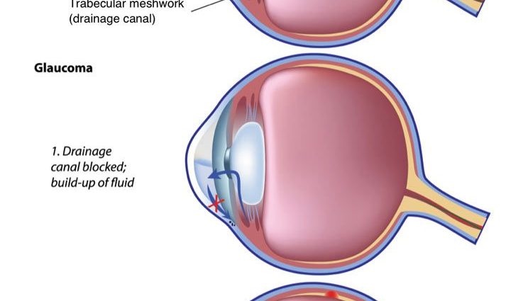 Glaucoma with normal intraocular pressure