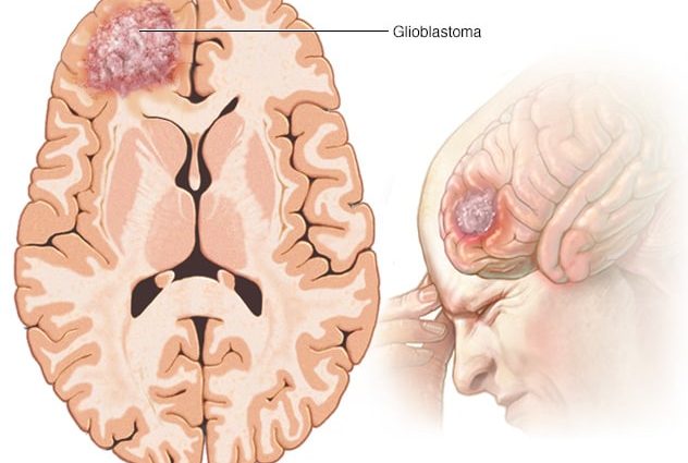 Glioblastoma multiforme &#8211; a malignant tumor of the brain