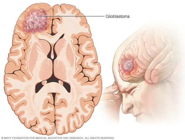 Glioblastoma multiforme &#8211; a malignant tumor of the brain