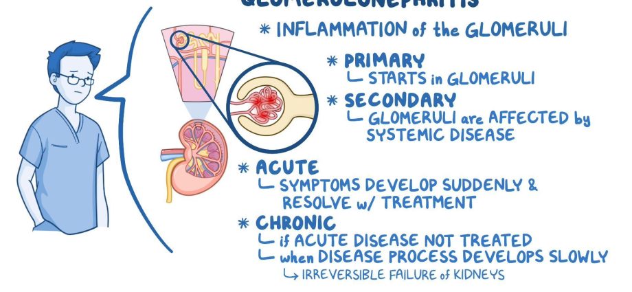 Glomerulonephritis &#8211; causes and treatment