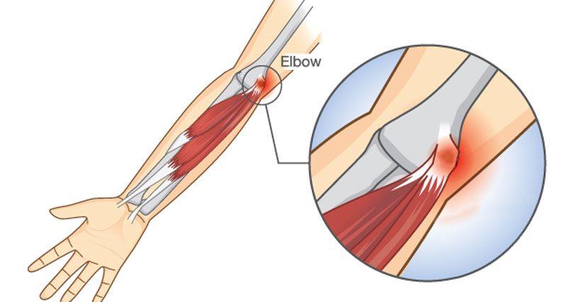 Golfer&#8217;s elbow &#8211; causes, symptoms, treatment. Rehabilitation of the golfer&#8217;s elbow