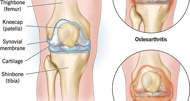 Gonartosis, or degeneration of the knee joint. Causes, symptoms, diagnosis, treatment