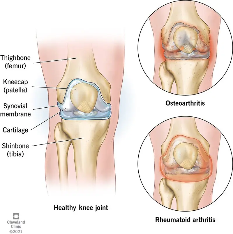 Gonartosis, or degeneration of the knee joint. Causes, symptoms, diagnosis, treatment