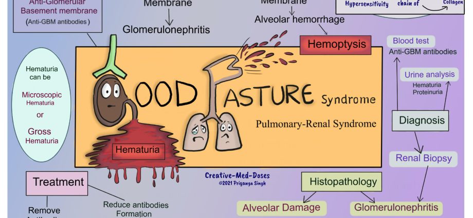 Goodpasture&#8217;s syndrome &#8211; the course of the disease