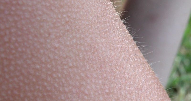 Goosebumps &#8211; what is it? Goose bumps and follicular keratosis