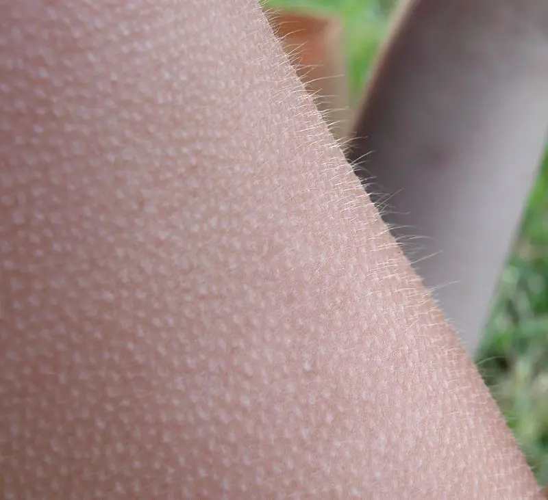 Goosebumps &#8211; what is it? Goose bumps and follicular keratosis