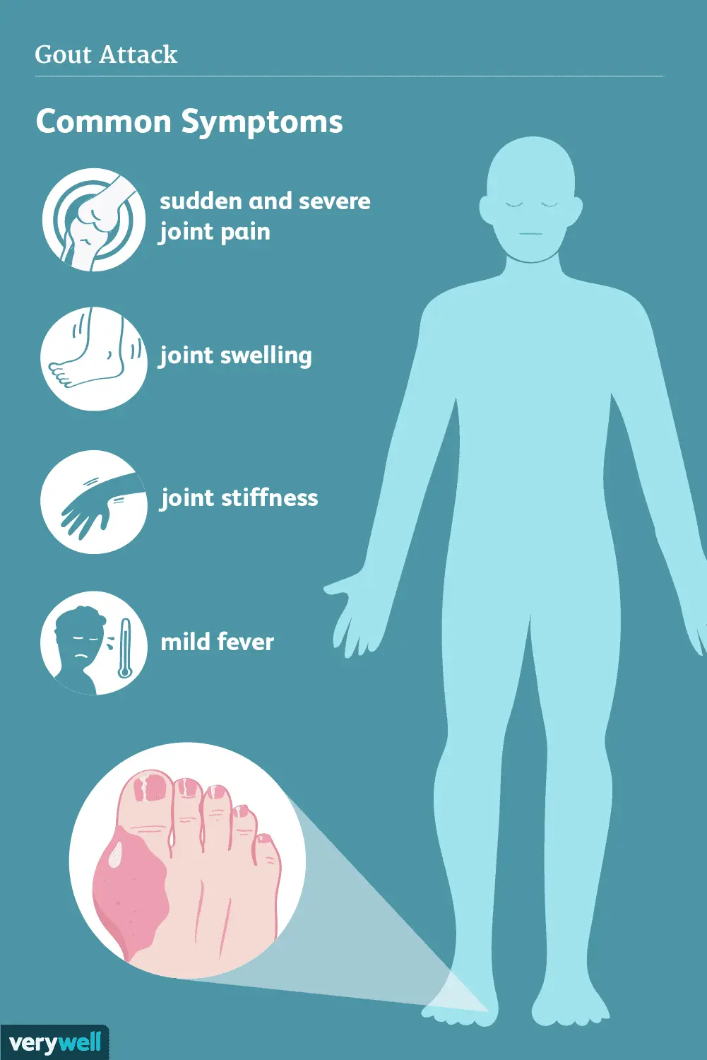 Gout &#8211; causes, symptoms, treatment. How to proceed in the case of a gout attack?