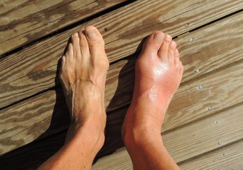 Gout &#8211; the disease of kings returns