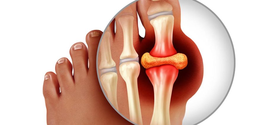 Gout &#8211; where does it come from? How does it manifest itself and how to treat gout? WE EXPLAIN