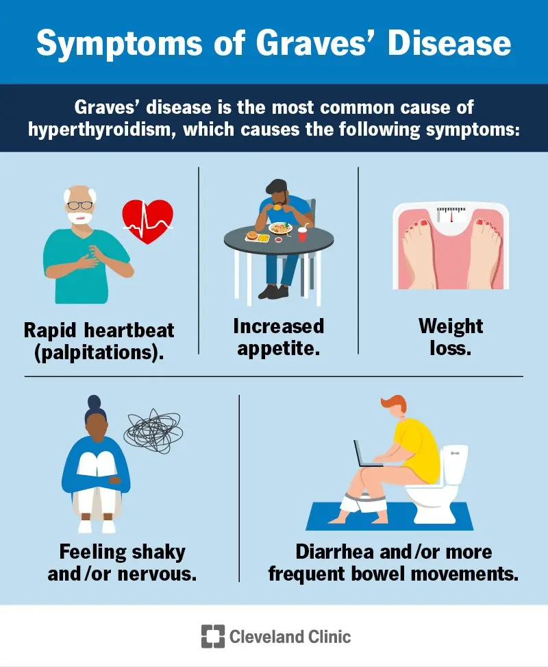 Graves&#8217; disease &#8211; causes, symptoms, treatment